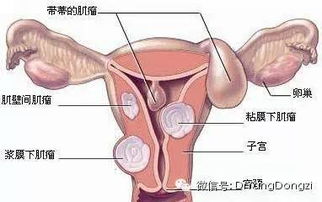 女子频繁掏耳朵长出近2厘米瘤